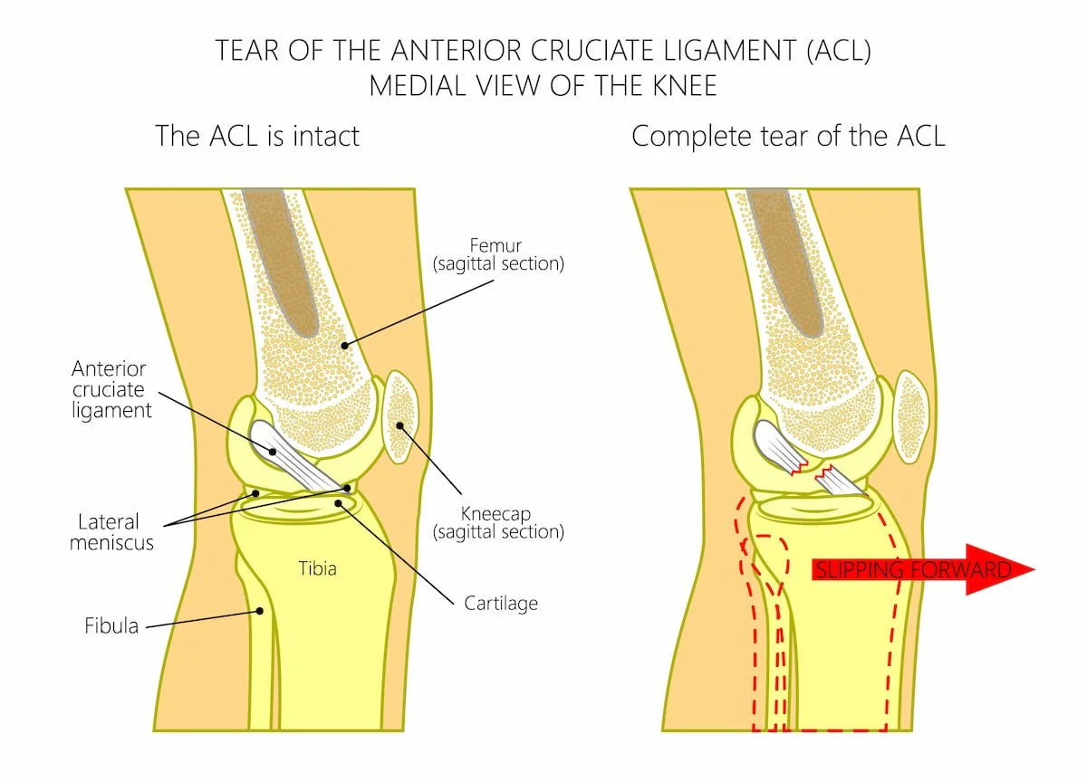 ACL Tear inforgraphic