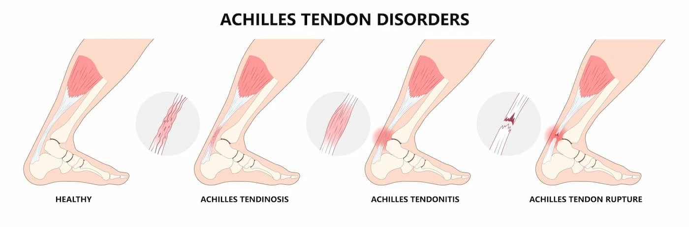 Achilles tendonitis disorder