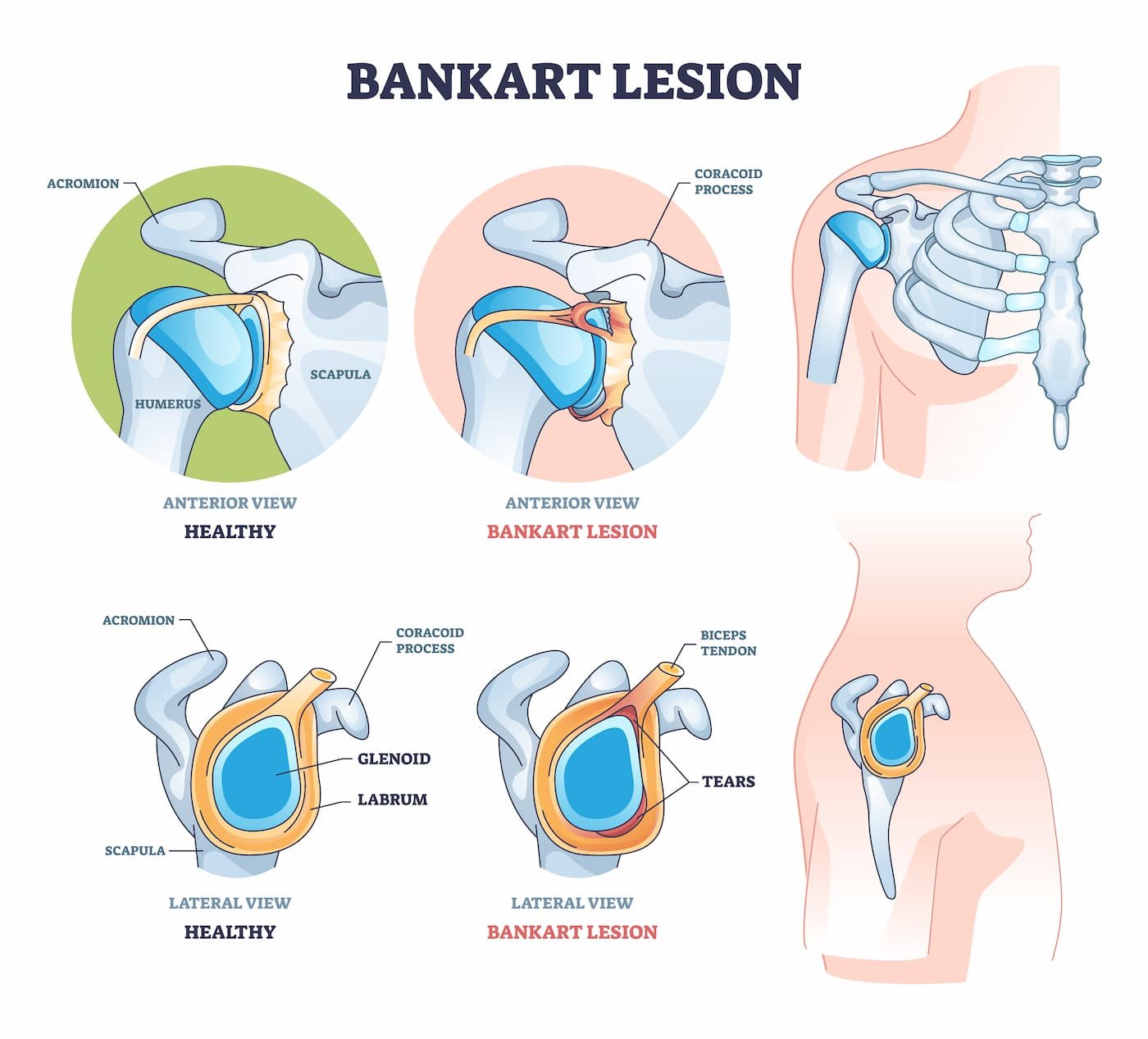 Bankart Lesion
