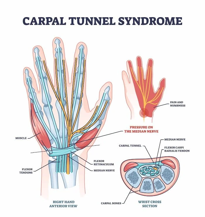 Carpal Tunnel