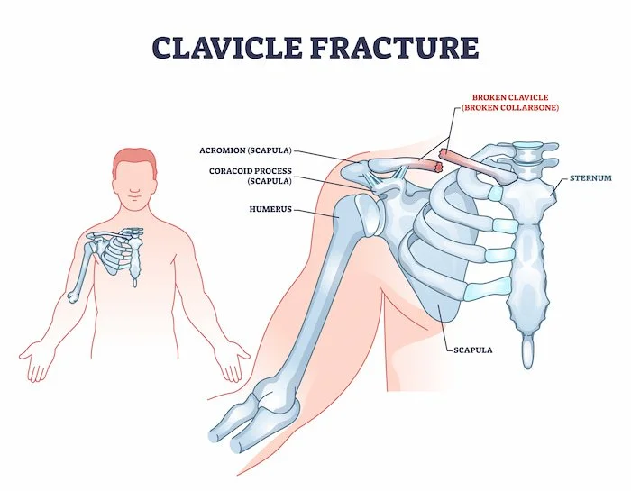 Clavicle fracture