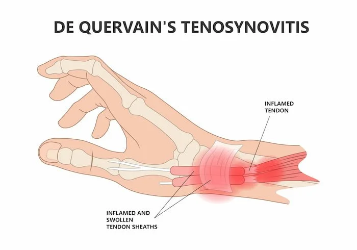 De quervain