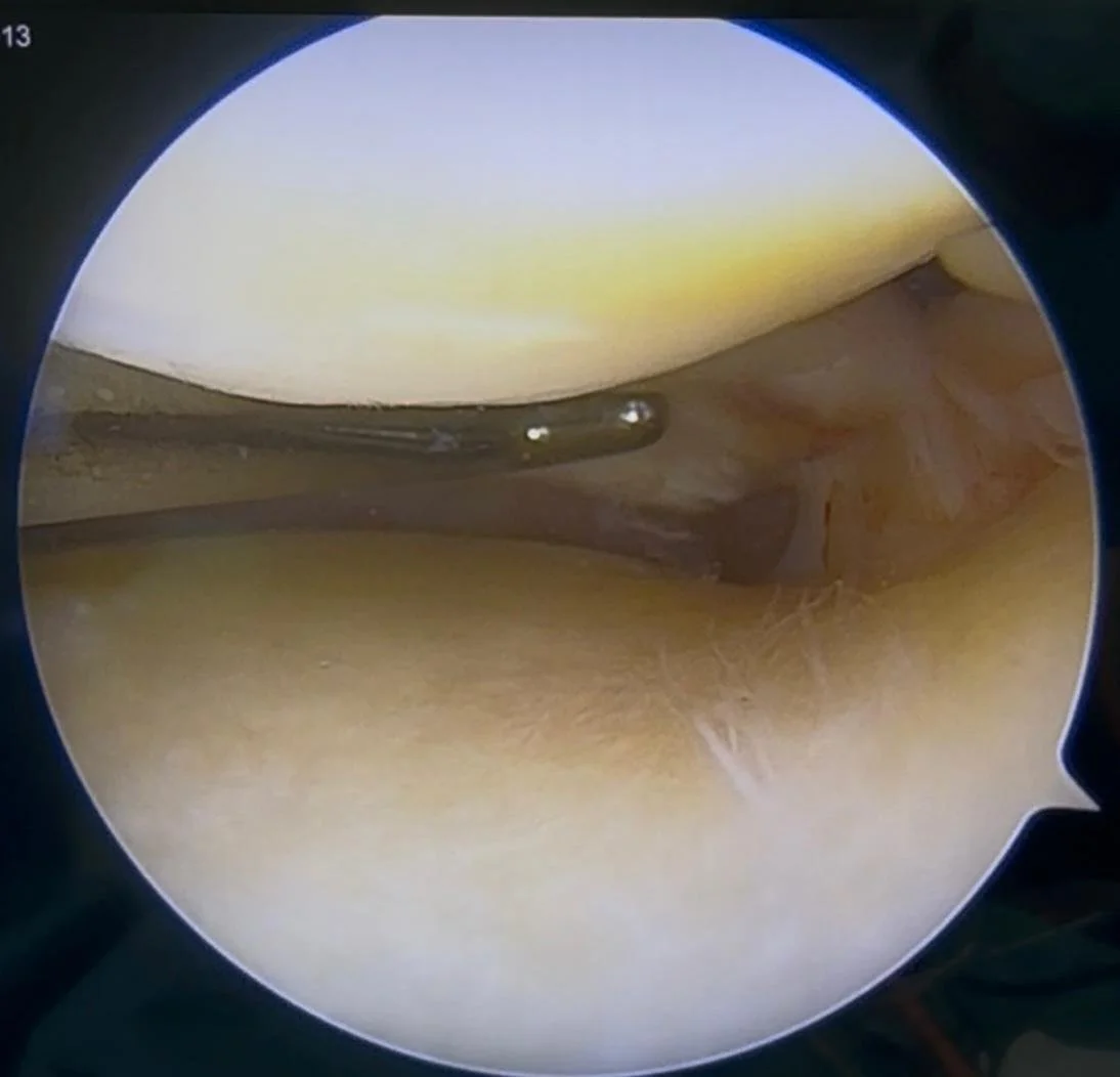 Dr Bryan meniscus root repair