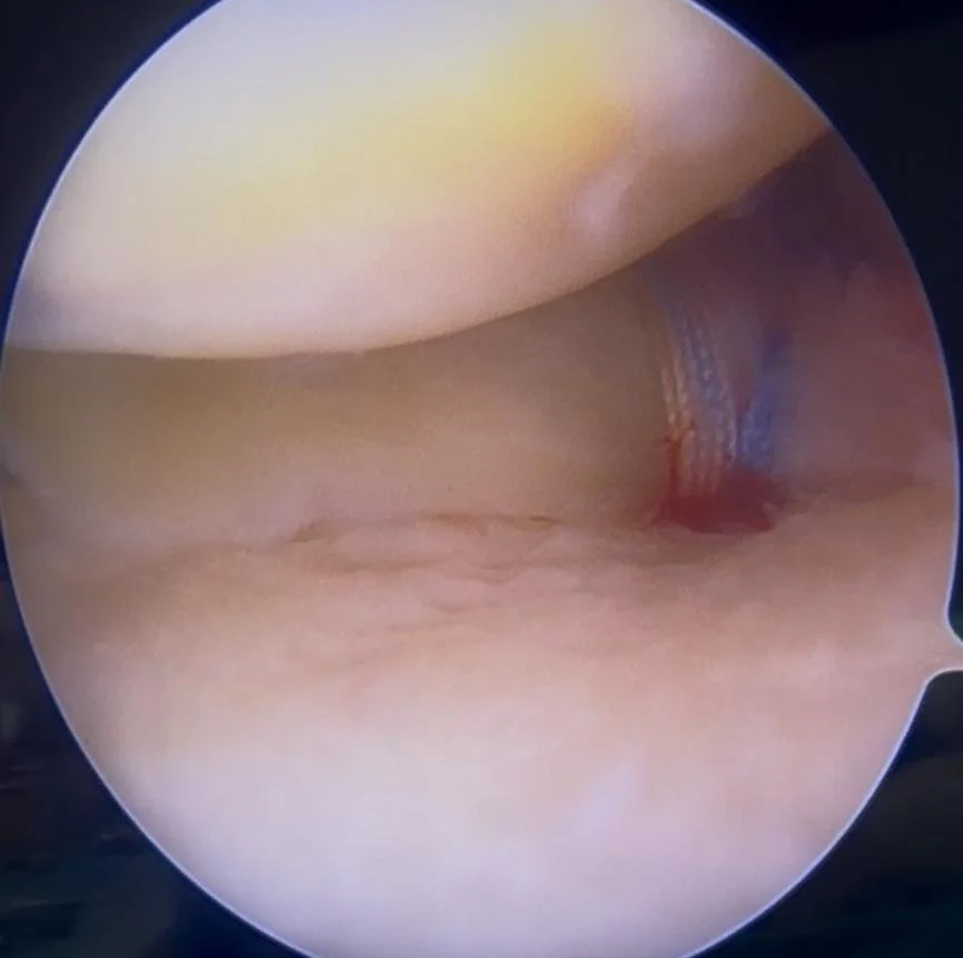 Dr Bryan meniscus root repair 2