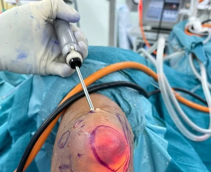 Elbow endoscopic olecranon bursectomy