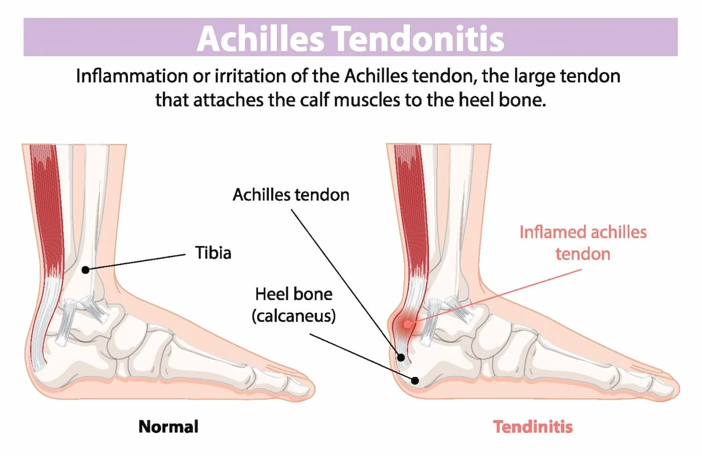 Foot ankle achilles tendonitis