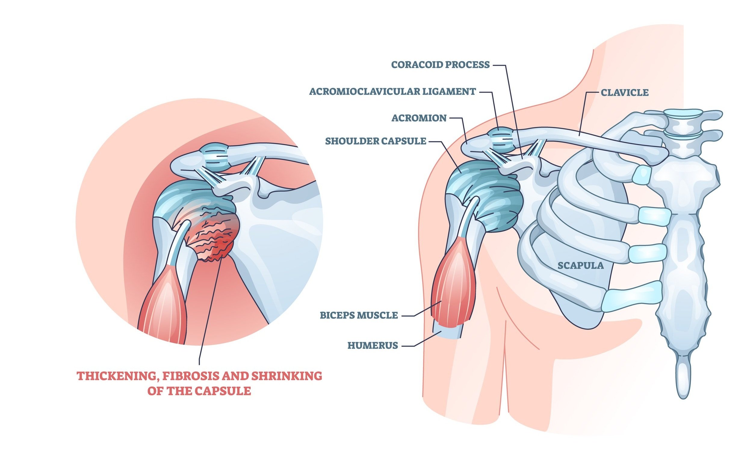 Frozen shoulder anatomy