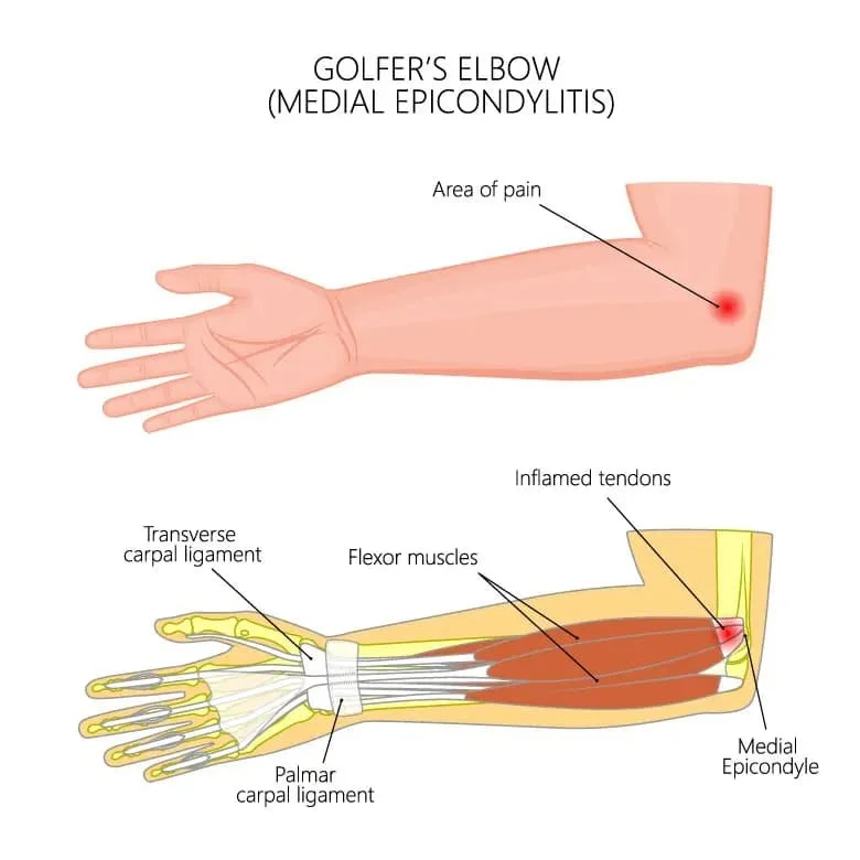 Golfer's elbow anatomy infographic