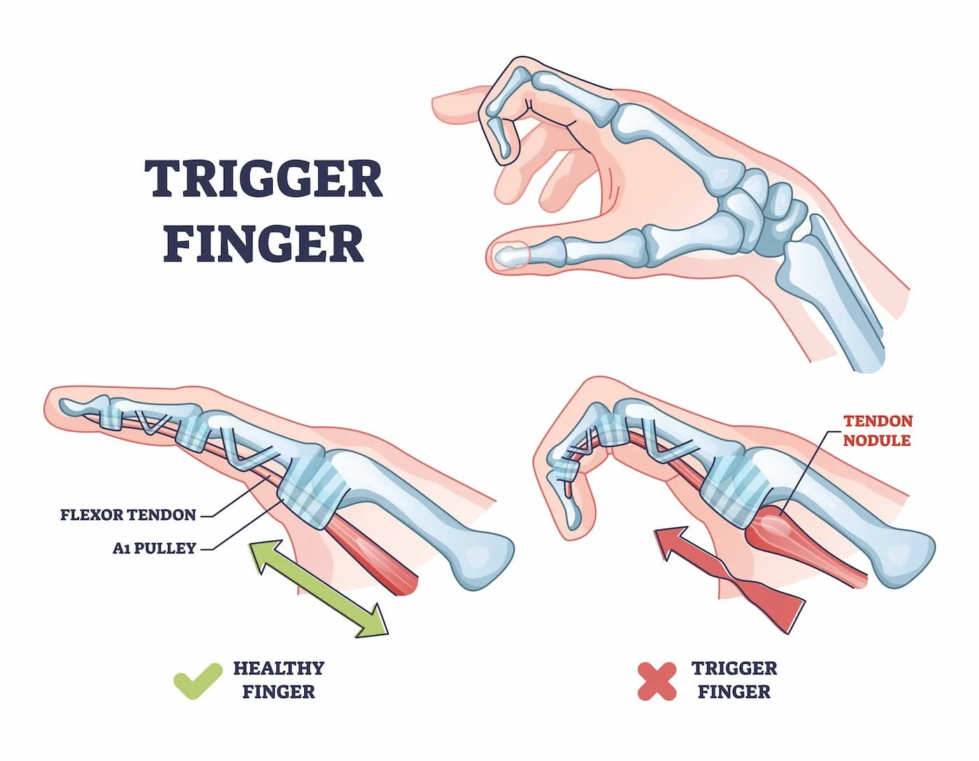 Hand Wrist trigger finger infographic