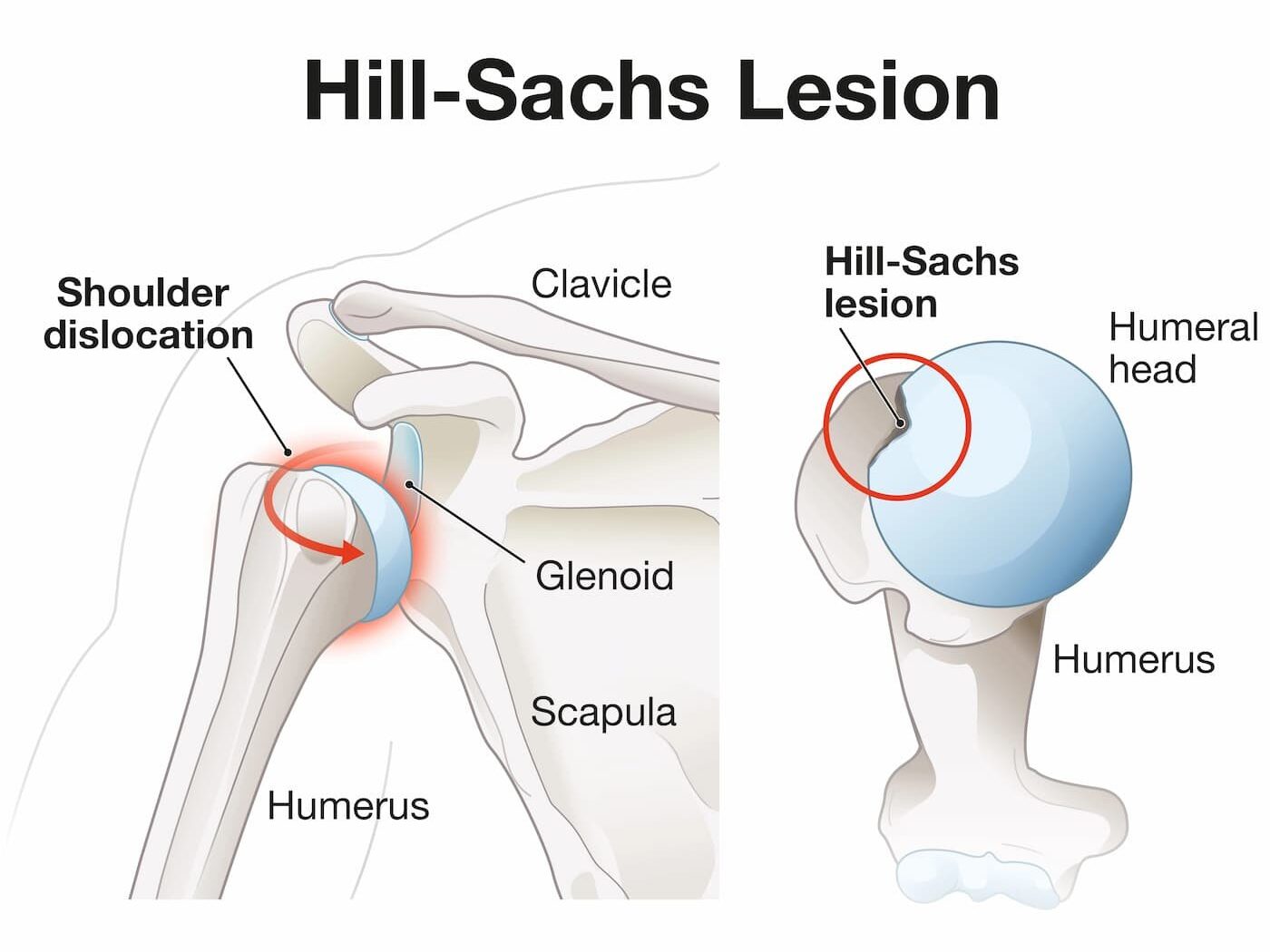 Hill-Sachs lesion