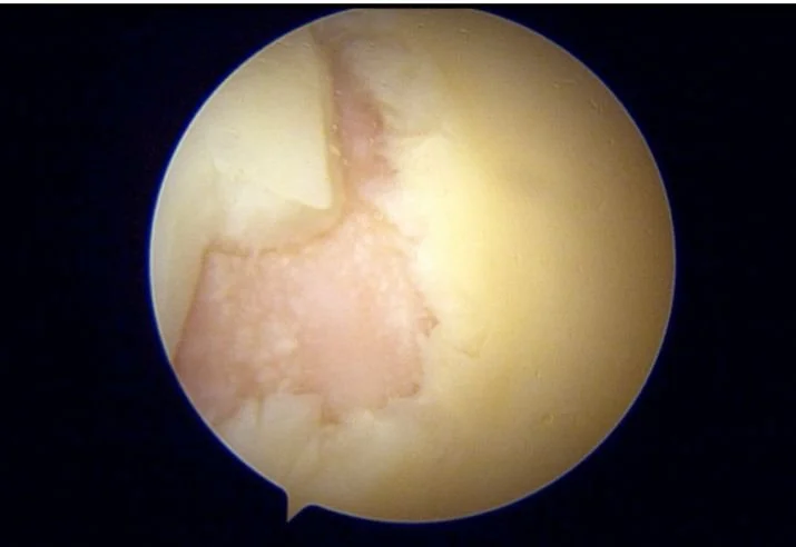 Knee cartilage repair