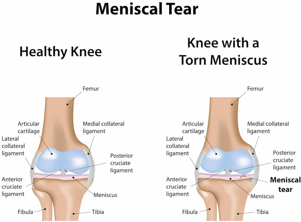 Knee Meniscus injury