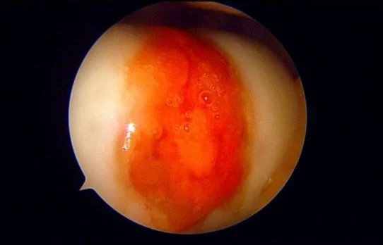 Knee cartilage repair scope image2