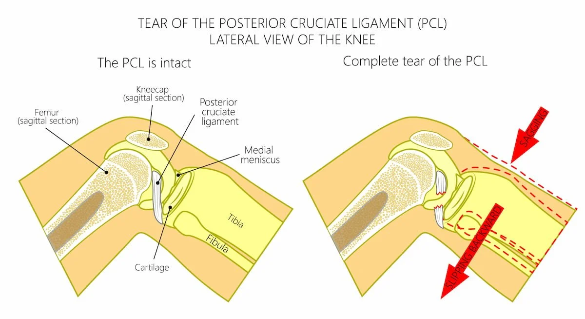 PCL Tear infographic
