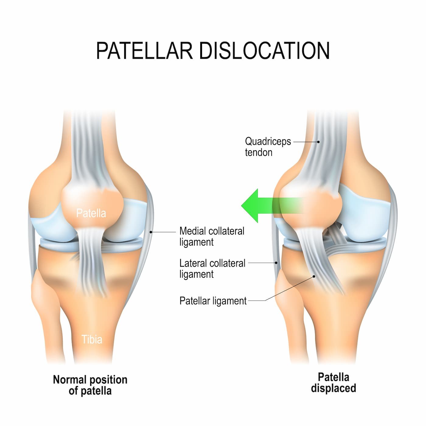 Patella dislocation
