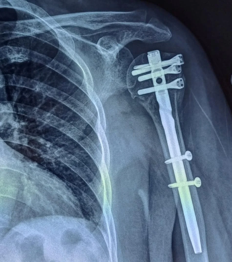 Proximal humerus fracture post op xray