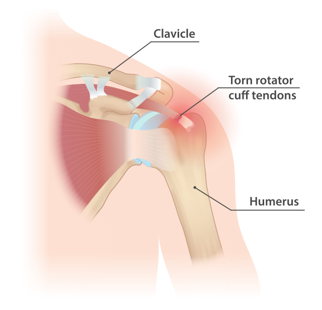 Rotator Cuff Specialist - Torn rotator cuff tendons infographic