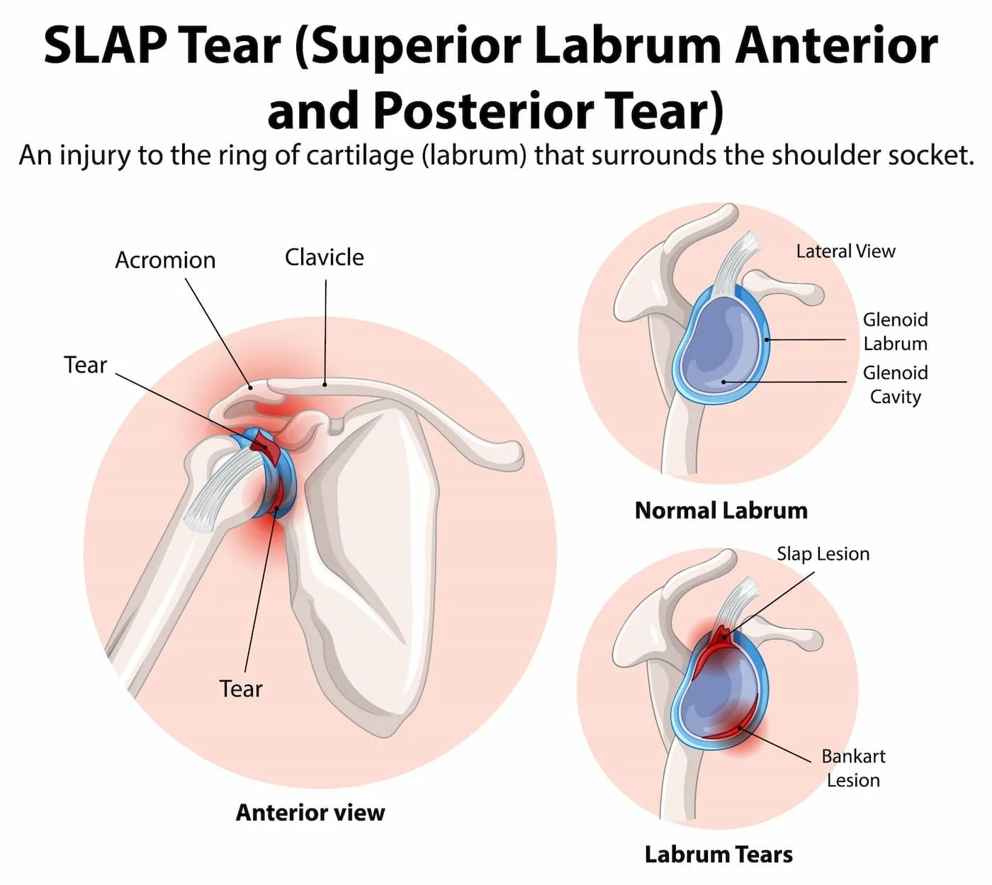 Shoulder SLAP tear