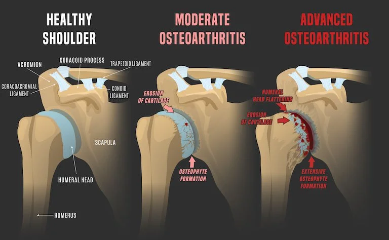Shoulder arthritis anatomy