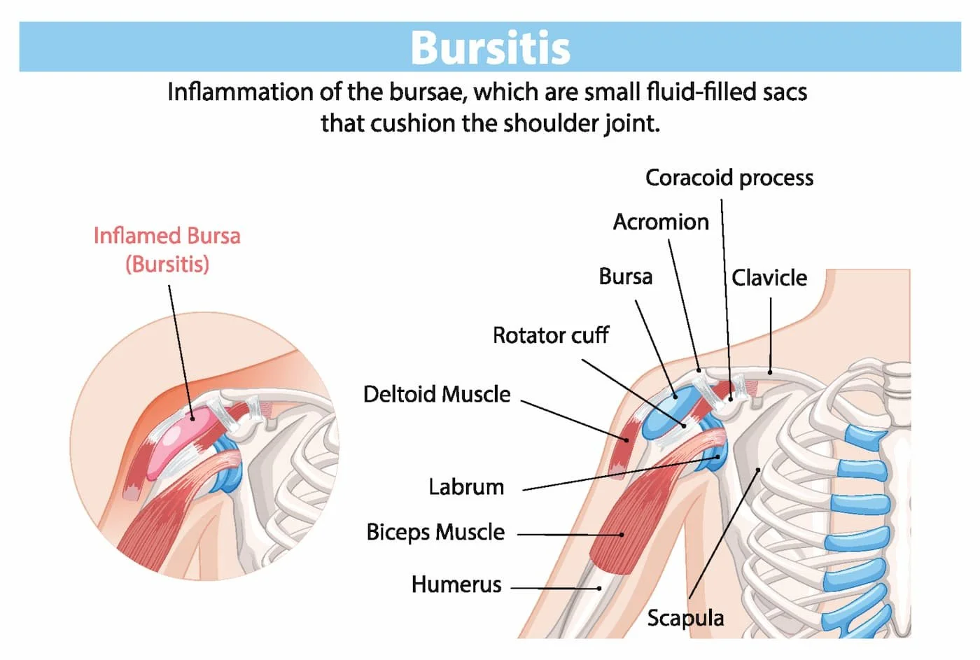 Shoulder bursitis