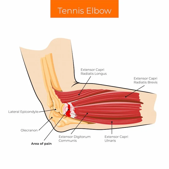 Tennis elbow