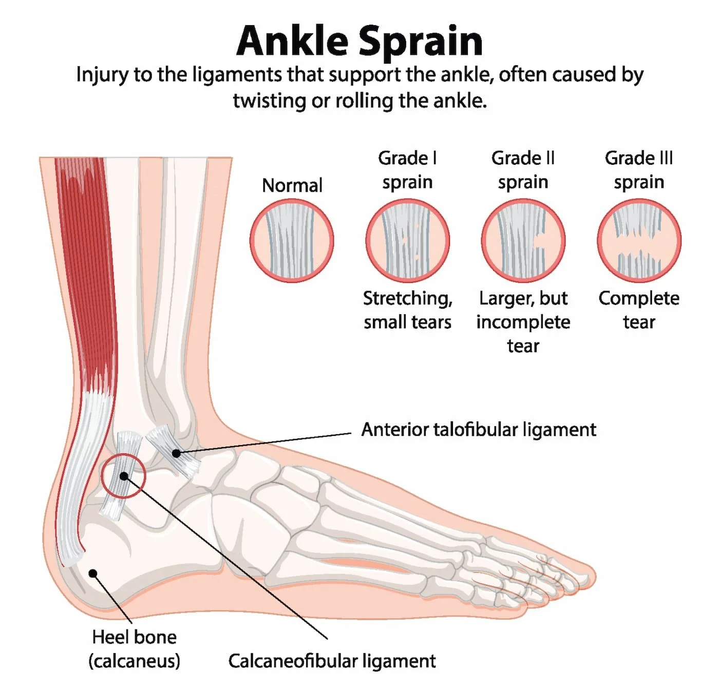Ankle sprain infographic