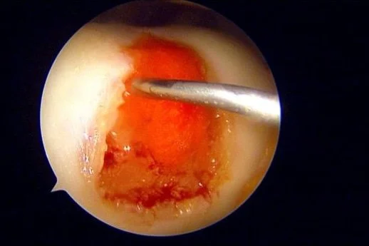 Knee cartilage repair scope image1