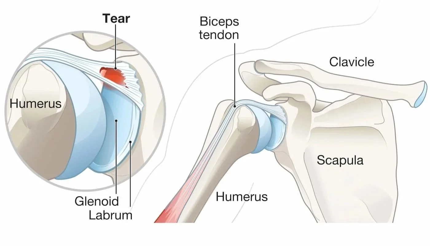 Shoulder labral tear specialist - Dr Bryan Wang