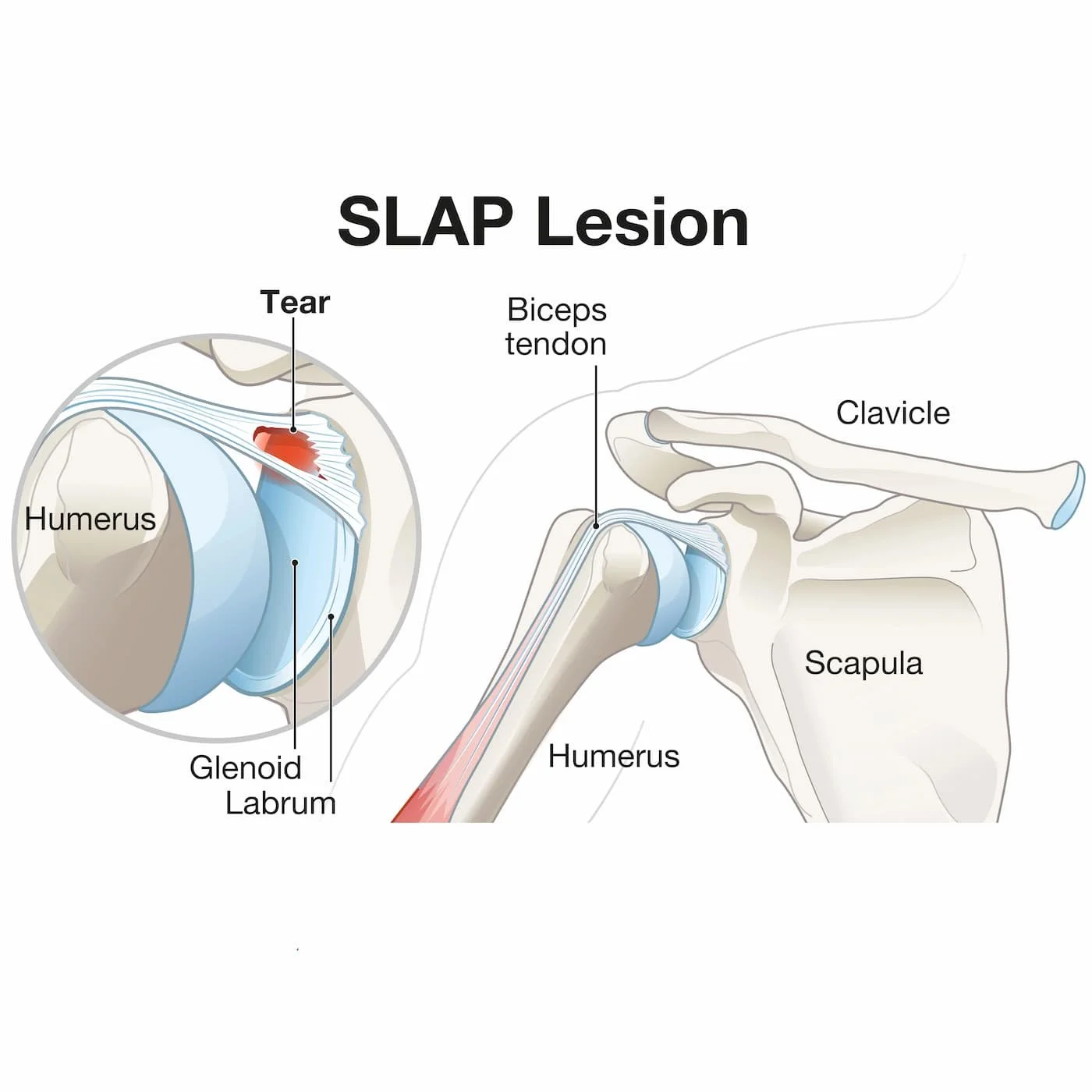 SLAP lesion infographic